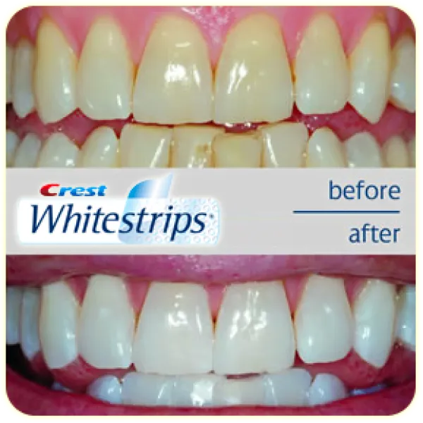 30004 alternative filling whitening