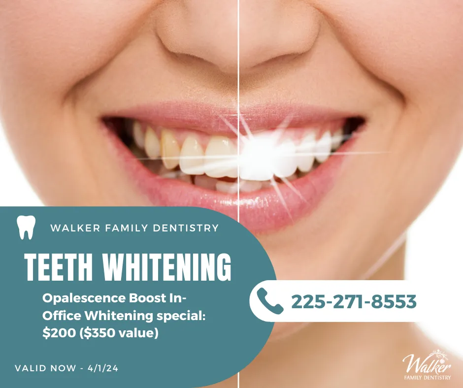 30009 at home whitening kit